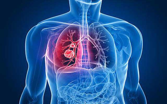 Natural healing of bronchitis
